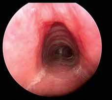 This picture was taken just below the vocal cords showing a completely open subglottic airway following placement of rib grafts. 