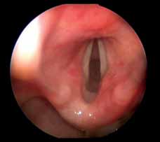 This picture was taken at the level of the vocal cords showing complete obstruction of the subglottic airway, just beyond the vocal cords.